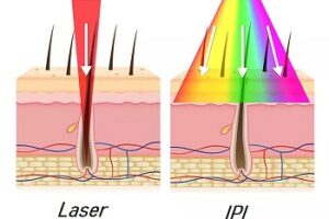 Luce pulsata o laser: tutto quello che c’è da sapere